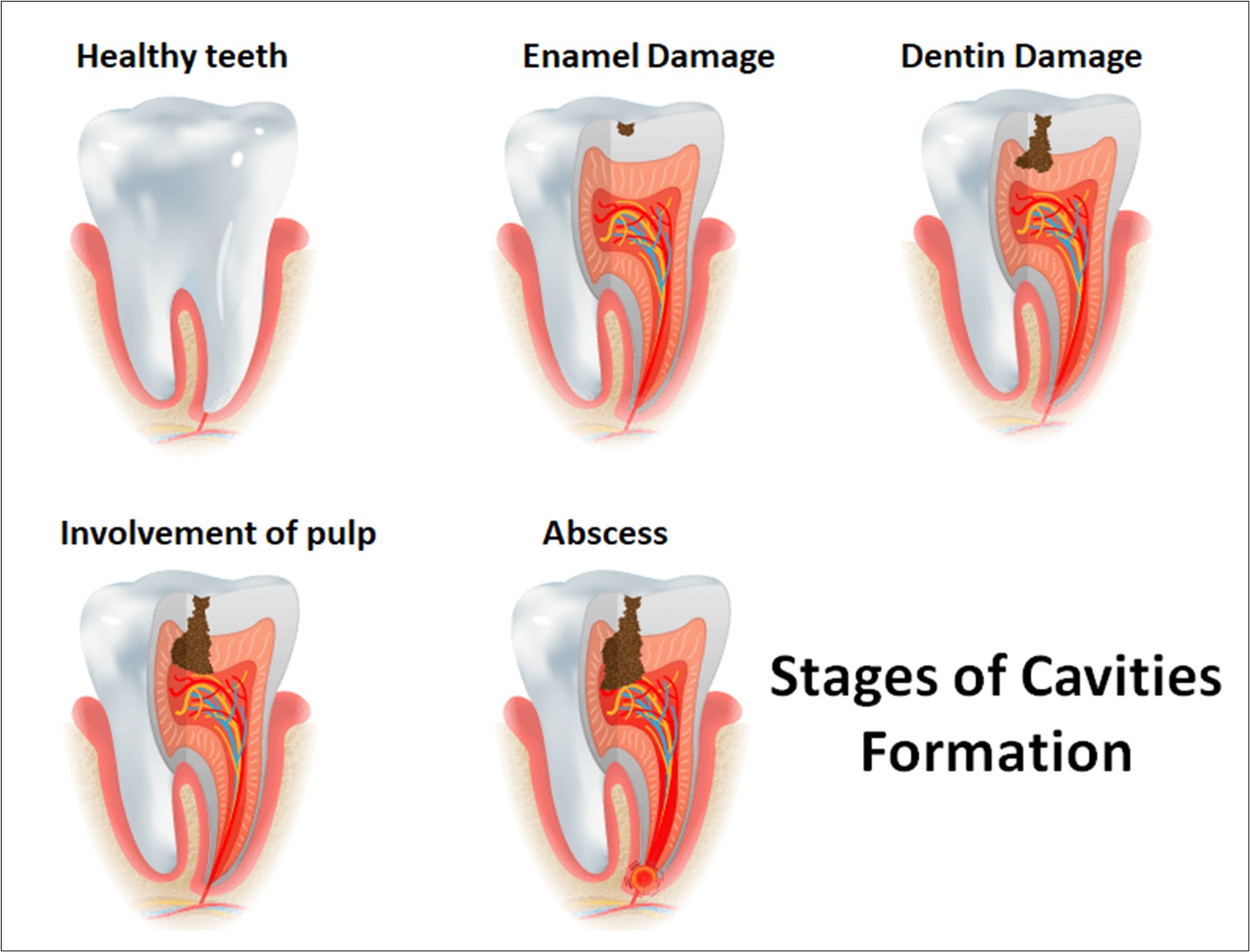 Prevent cavities before they start: know about maintaining optimal Oral ...